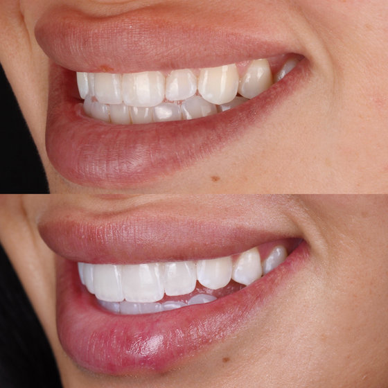 Smile transformation 1