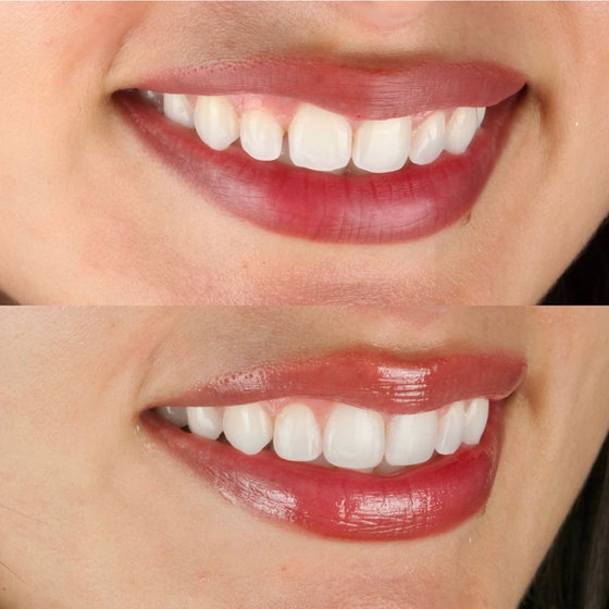 Smile transformation 2