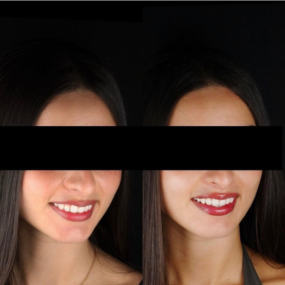 Smile transformation 3