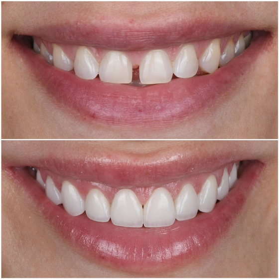 Smile transformation 4