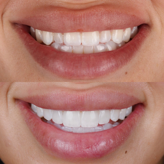 Smile transformation 5