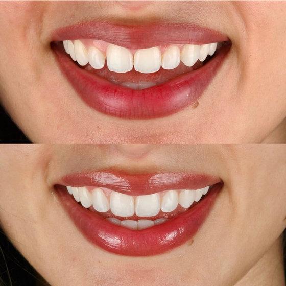 Smile transformation 6