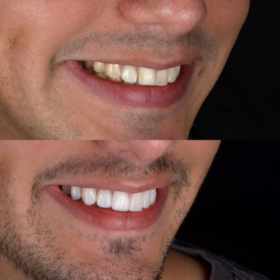 Smile transformation 10