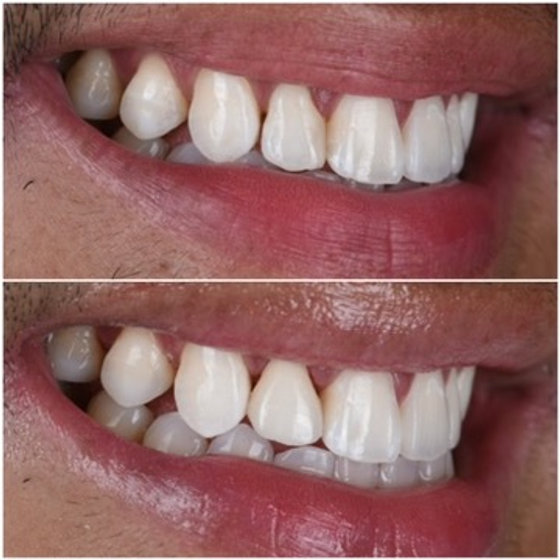 Smile transformation 11