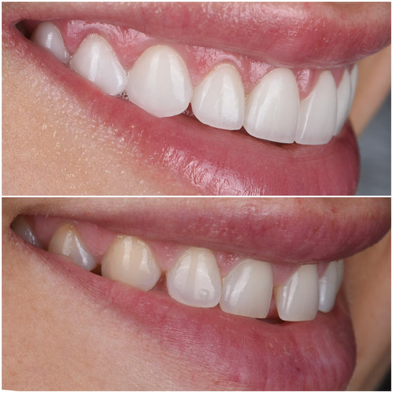 Smile transformation 13