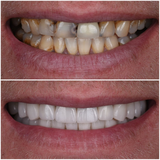 Smile transformation 14