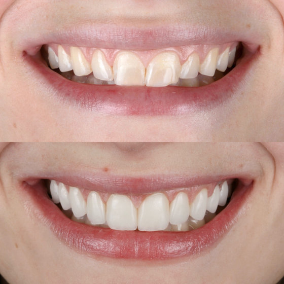 Smile transformation 15