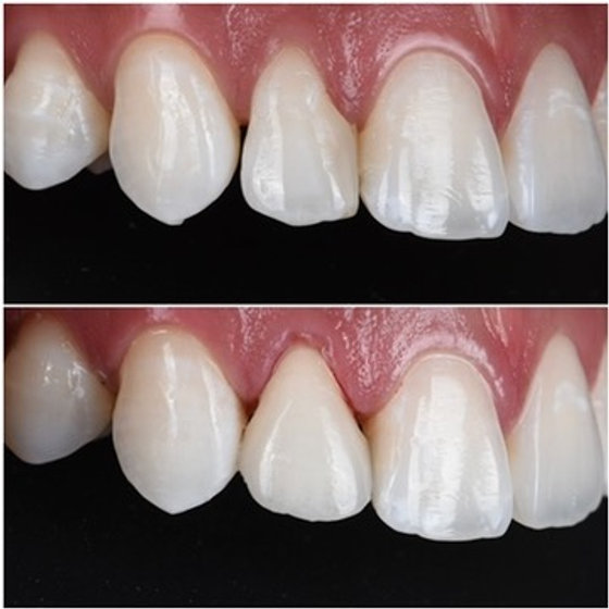 Smile transformation 16
