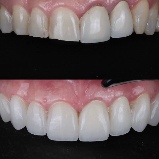 Smile transformation 17