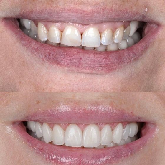 Smile transformation 18