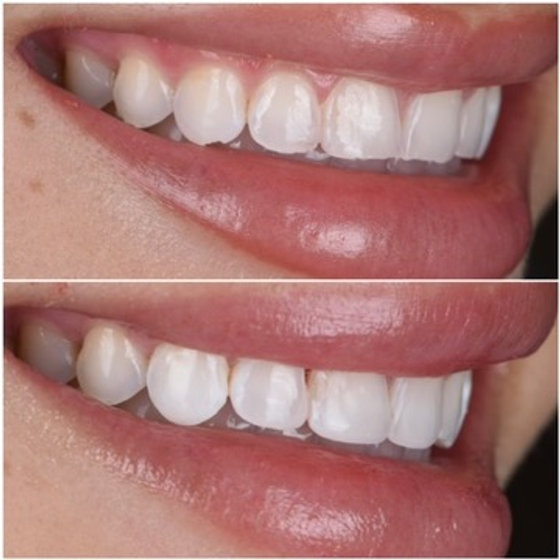 Smile transformation 1