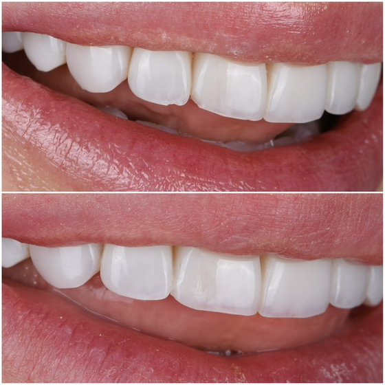 Smile transformation 2