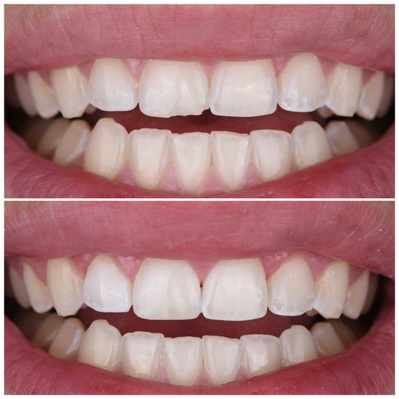 Smile transformation 3