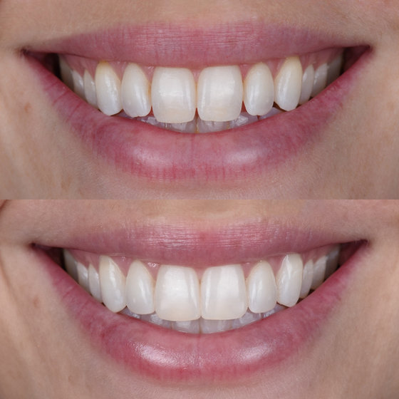 Smile transformation 4