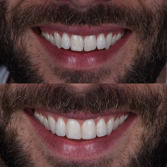 Smile transformation 5