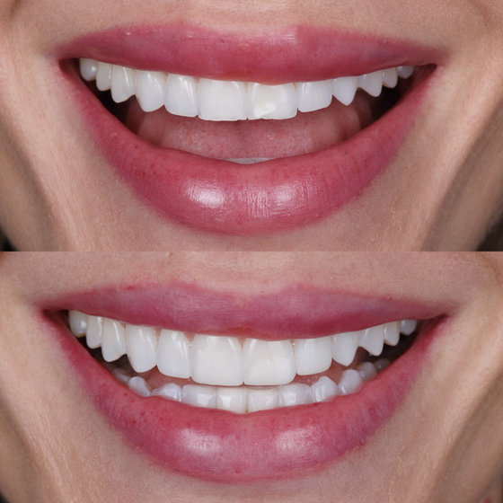Smile transformation 6