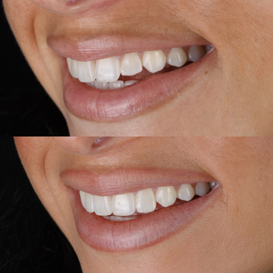 Smile transformation 9