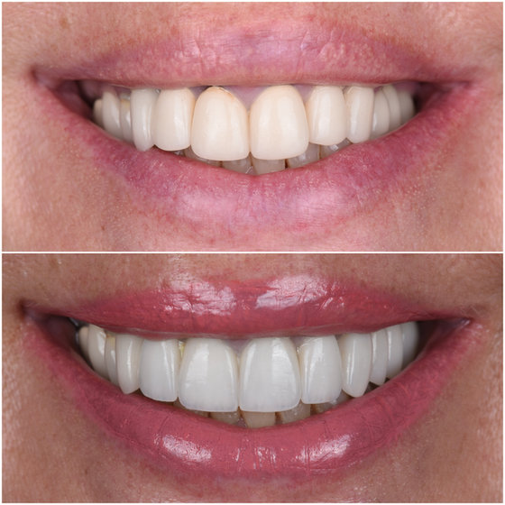 Smile transformation 1