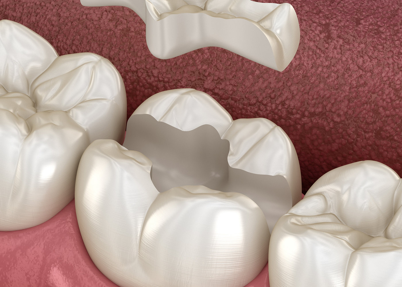 Porcelain inlay and onlay restorations