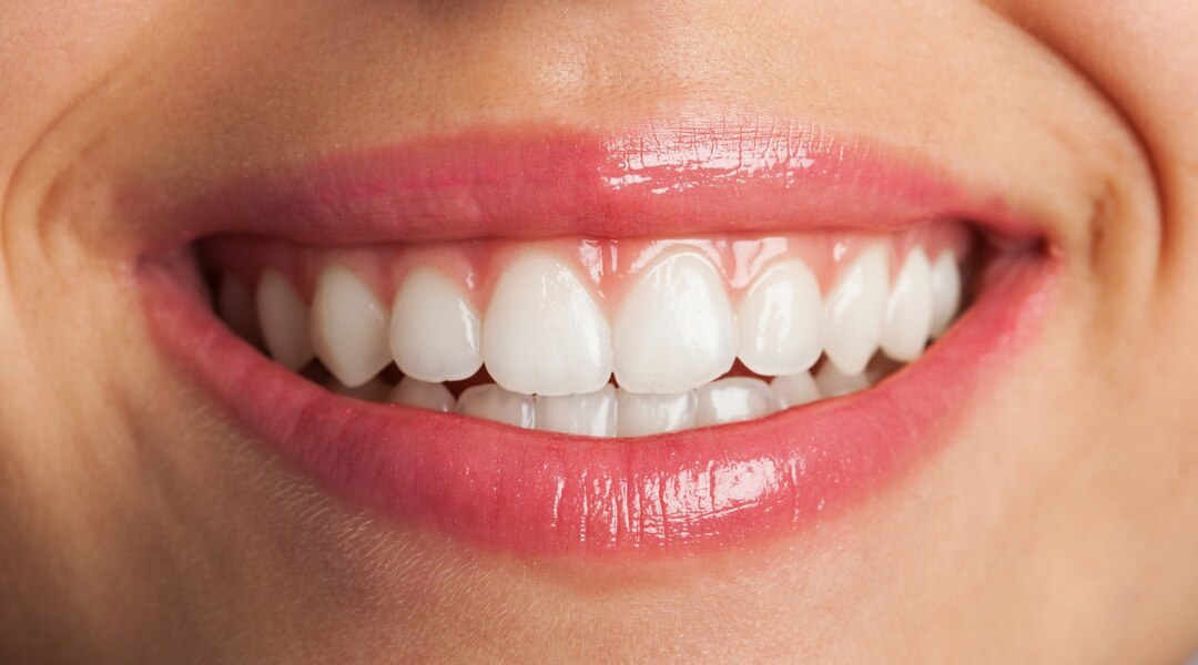Porcelain veneers