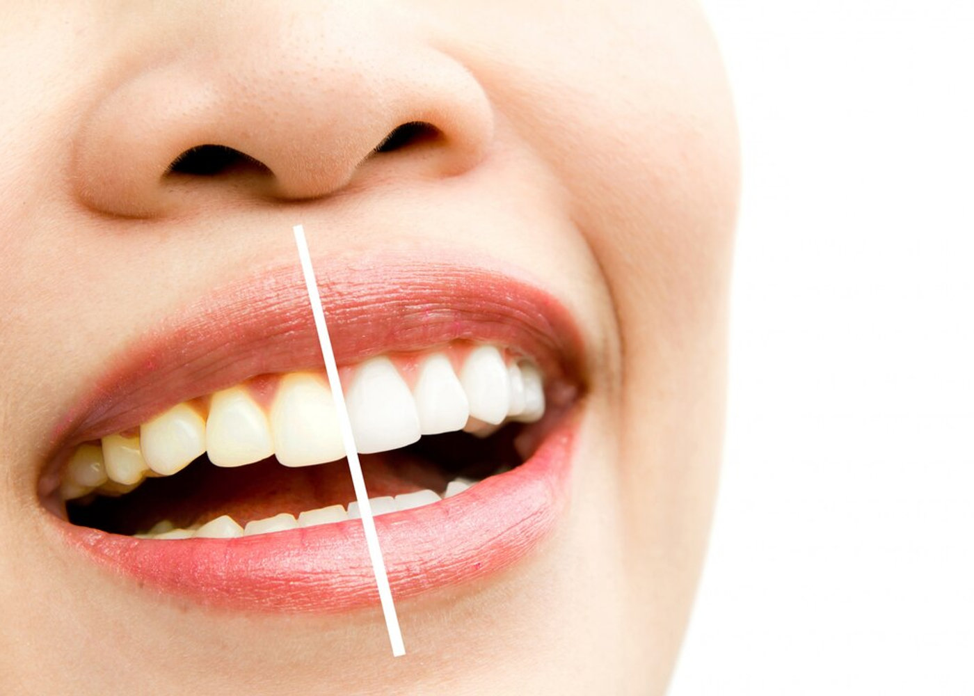 Professional teeth whitening treatment
