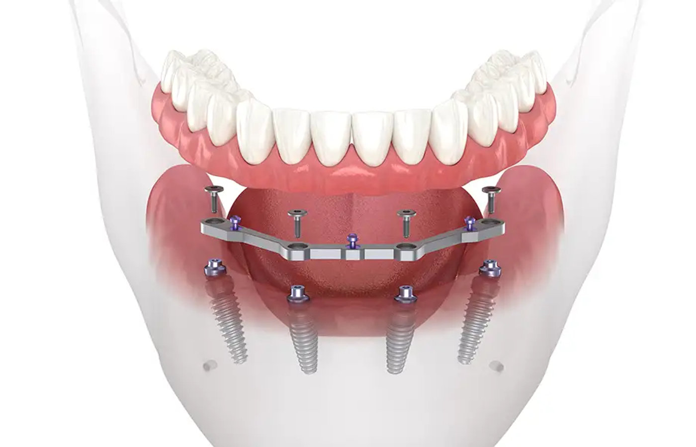 All-on-4 implant diagram
