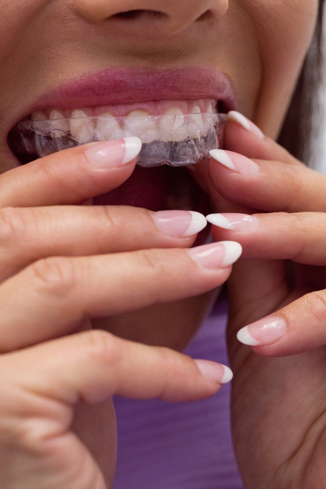 Invisalign clear aligner