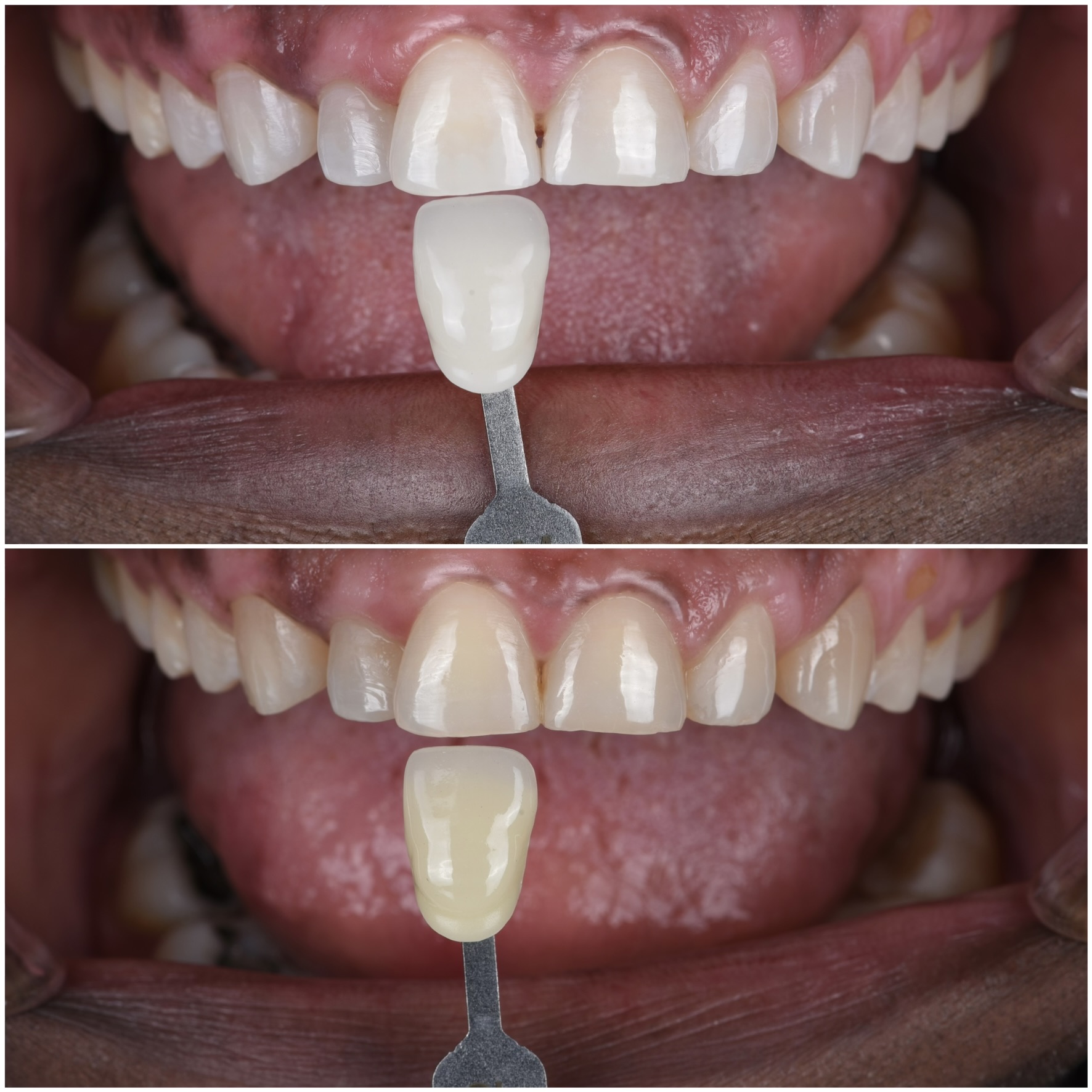 Why teeth become discolored