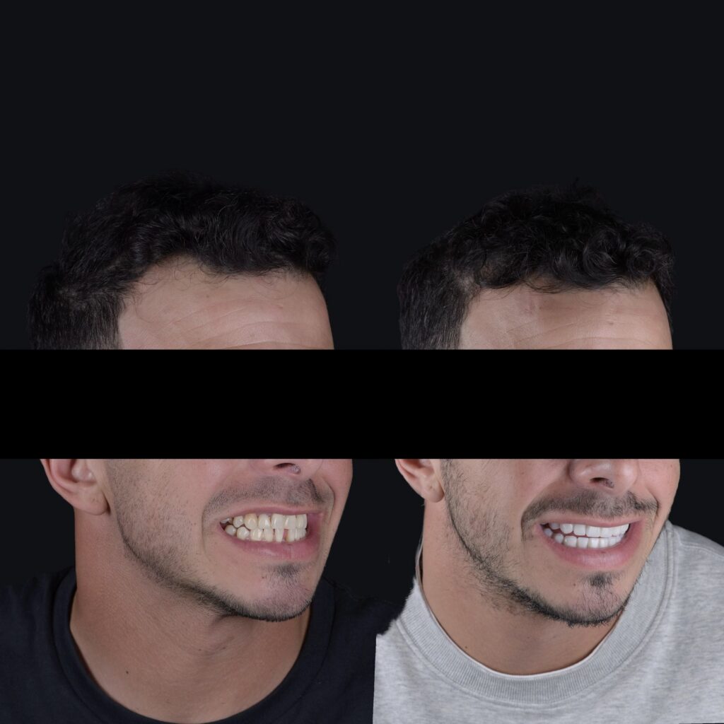Full smile makeover with veneers before and after, male patient, Aventura cosmetic dentistry
