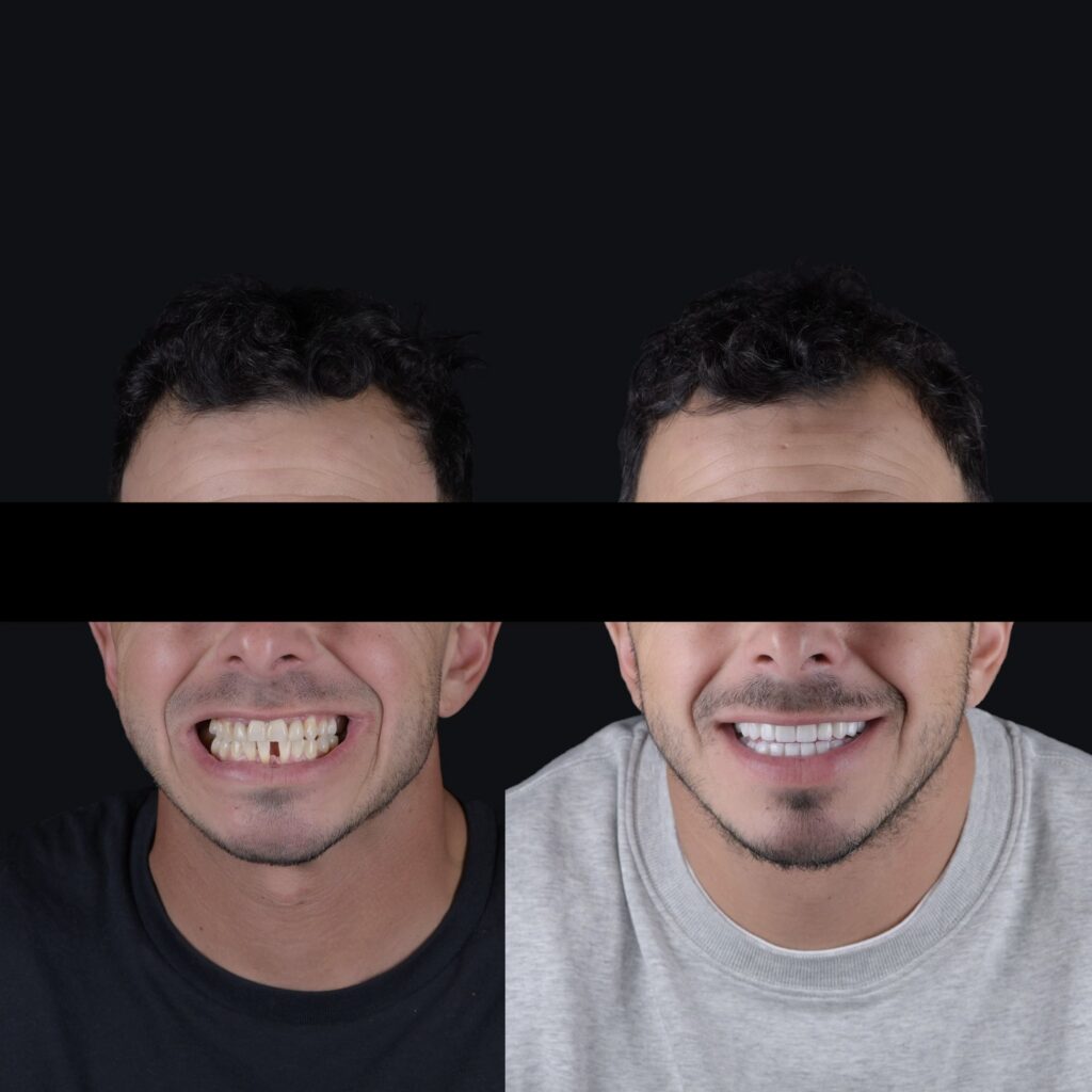 Veneers before and after full face results, male patient at BOND Aesthetic in Aventura, FL
