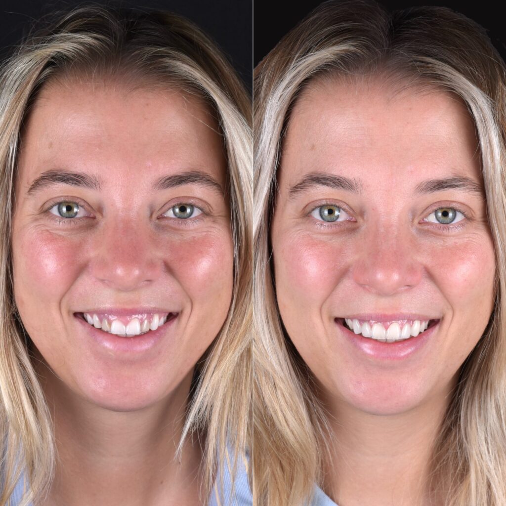 Veneers before and after for a female patient with a full smile transformation, Aventura cosmetic dentistry